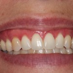 Smile Gallery Case 1 Gum Graft After Photo 