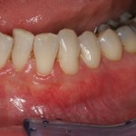 Smile Gallery Case 2 Gum Graft After Photo 