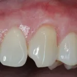 Smile Gallery  Case 3 Gum Graft After Photo 