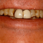 Smile Gallery Full Mouth Dental Implants Case 1 Before Photo