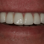 Smile Gallery Full Mouth Dental Implants Case 1 After Photo