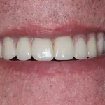 Smile Gallery Full Mouth Dental Implants Case 2 After Photo