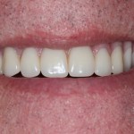 Smile Gallery Full Mouth Dental Implants Case 2 After Photo