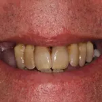 Smile Gallery Full Mouth Dental Implants Case 2 Before Photo