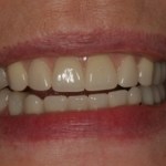 Smile Gallery Full Mouth Dental Implants Case 3 After Photo