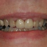 Smile Gallery Full Mouth Dental Implants Case 3 Before Photo