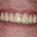 Smile Gallery Full Mouth Dental Implants Case 4 After Photo