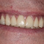 Smile Gallery Full Mouth Dental Implants Case 4 After Photo