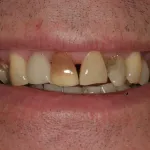 Smile Gallery Full Mouth Dental Implants Case 4 Before Photo
