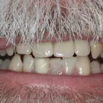 Smile Gallery Single Tooth Implant Case 1 After Photo