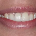 Smile Gallery Single Tooth Implant Case 2 After Photo