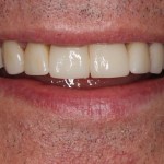 Smile Gallery Single Tooth Implant Case 3 After Photo