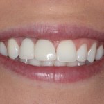 Smile Gallery Single Tooth Implant Case 4 After Photo