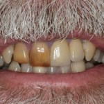 Smile Gallery Single Tooth Implant Case 1 Before Photo