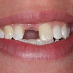 Smile Gallery Single Tooth Implant Case 2 Before Photo