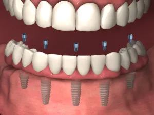 Illustration of TeethXpress implants placed